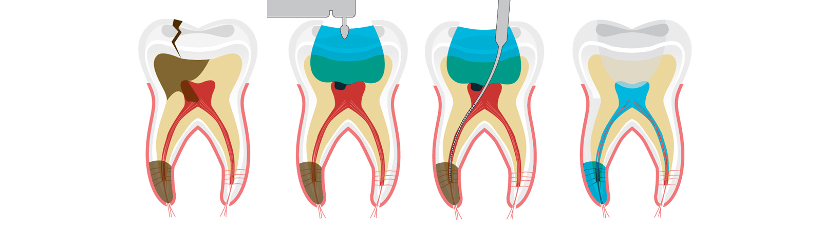 Endodoncia, Desvitalización de Piezas Dentales - Clínica Dental Txabarri